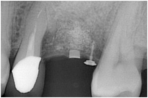 篠崎4 GBR　抜歯後4ヶ月半・GBR後